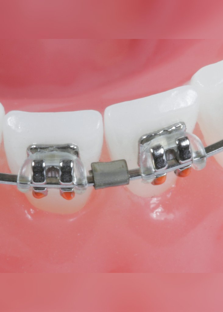 Crimp Archwire Stops crimps 014 - 21x25 (10UN)
