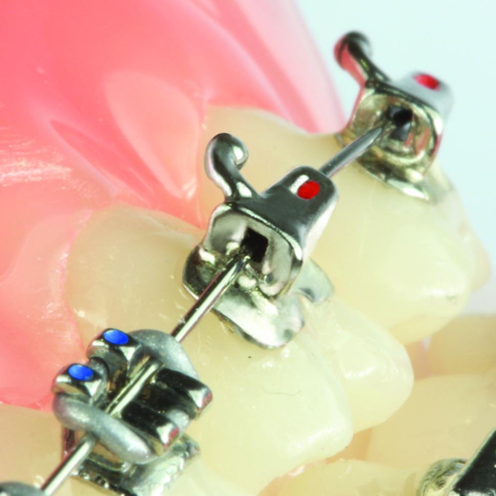 Evolve 2nd molar Roth tube 022 LL (UN)